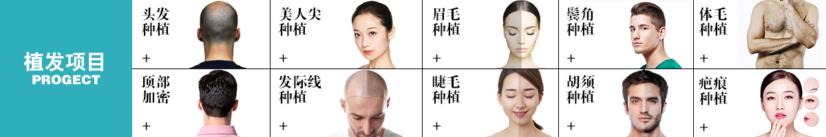 植发项目大全