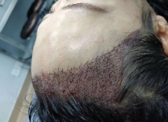 女士发际线调整