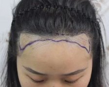 发际线调整效果案例